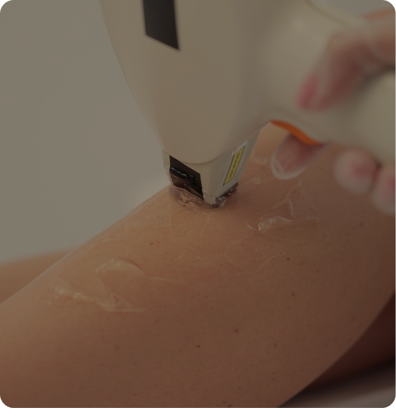 hair reduction laser